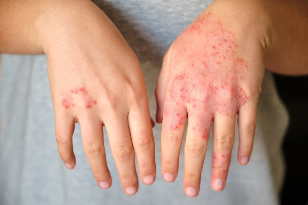 Tratamento da dermatite atópica (Foto: Reprodução)